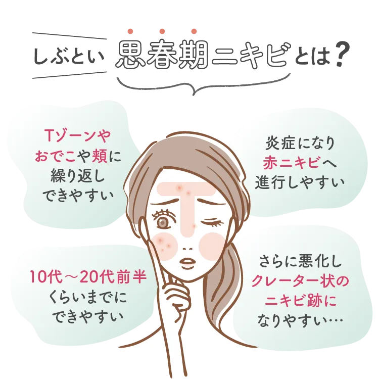 しぶとい思春期ニキビとは？