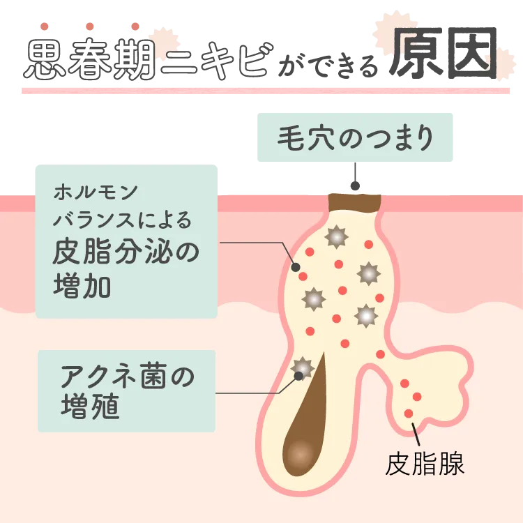思春期ニキビができる原因